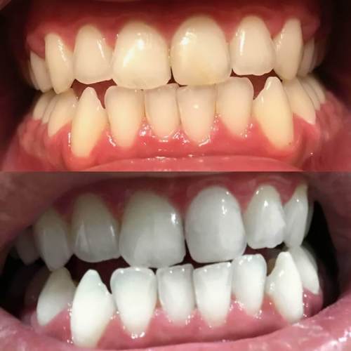 Teeth Whitening Pen